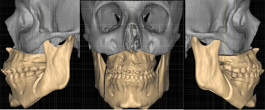 Simulação e resultado de cirurgia ortognática sob medida realizada com amparo de plano médico